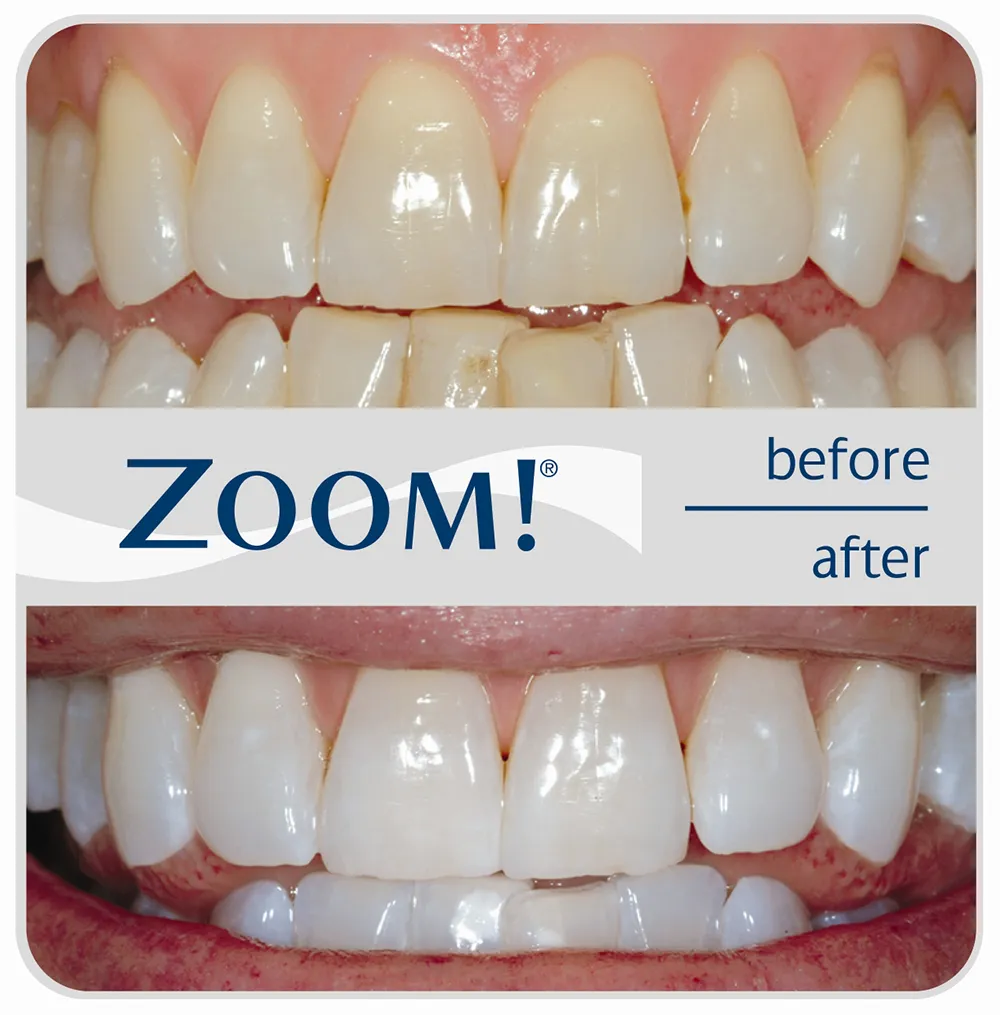 Smile before and after professional Zoom teeth whitening