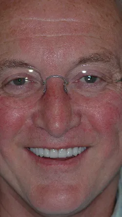 Smile after cosmetic dental treatment, gallery case 2