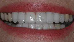 Smile after cosmetic dental treatment, gallery case 3 detail view
