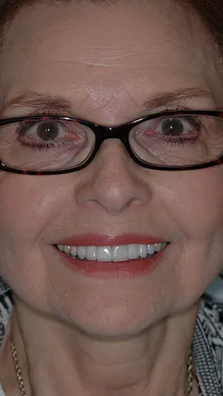 Smile after cosmetic dental treatment, gallery case 3