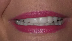 Smile after cosmetic dental treatment, gallery case 5 detail view
