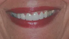 Smile after cosmetic dental treatment, gallery case 7 detail view