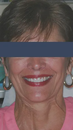 Smile after cosmetic dental treatment, gallery case 7