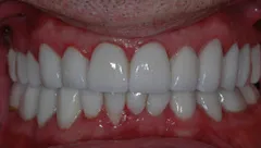 Smile after cosmetic dental treatment, gallery case 11 detail view