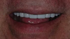 Smile after cosmetic dental treatment, gallery case 12 detail view