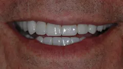 Smile after cosmetic dental treatment, gallery case 23 detail view