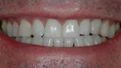 Smile after cosmetic dental treatment, gallery case 24 detail view