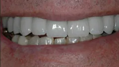 Smile after cosmetic dental treatment, gallery case 25 detail view