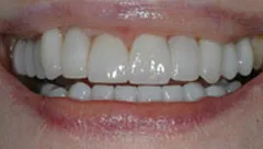 Smile after cosmetic dental treatment, gallery case 26 detail view
