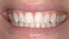 Smile after cosmetic dental treatment, gallery case 30