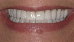Smile after cosmetic dental treatment, gallery case 33