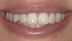 Smile after cosmetic dental treatment, gallery case 40