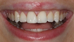 Smile after cosmetic dental treatment, gallery case 43