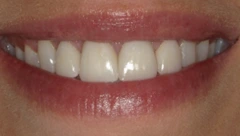 Smile after cosmetic dental treatment, gallery case 45