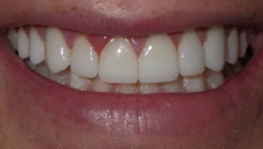 Smile after cosmetic dental treatment, gallery case 47
