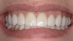 Smile after cosmetic dental treatment, gallery case 48