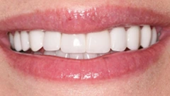 Smile after cosmetic dental treatment, gallery case 50