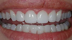 Smile after cosmetic dental treatment, high school reunion case