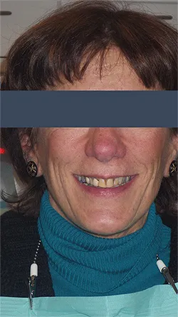 Smile before cosmetic dental treatment, gallery case 1 detail view