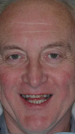 Smile before cosmetic dental treatment, gallery case 2