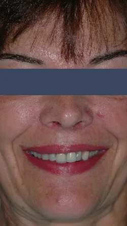 Smile before cosmetic dental treatment, gallery case 7