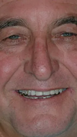 Smile before cosmetic dental treatment, gallery case 25